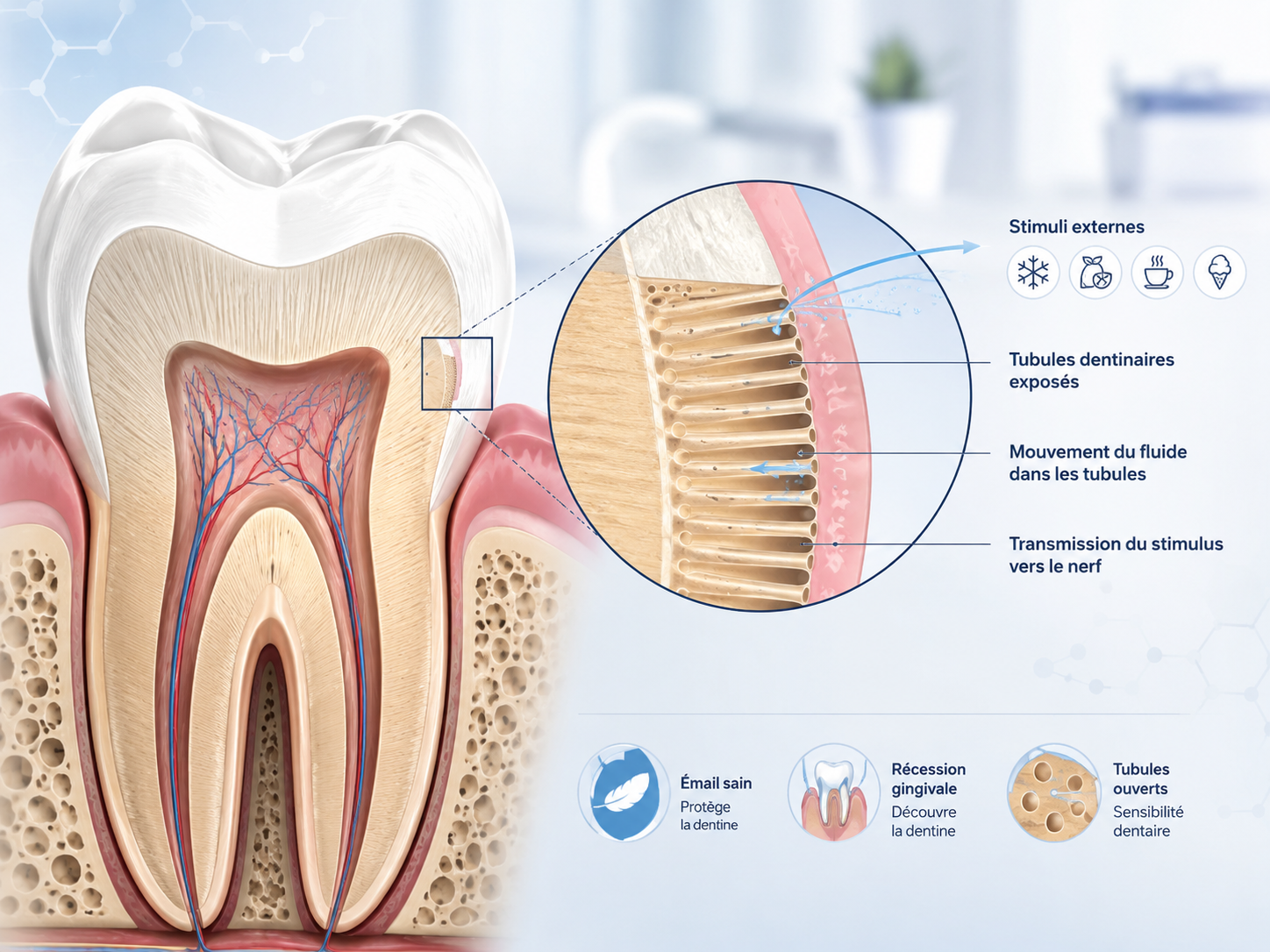 llustration coupe d'une dent montrant les tubules dentinaires exposés en cas d'hypersensibilité dentaire
