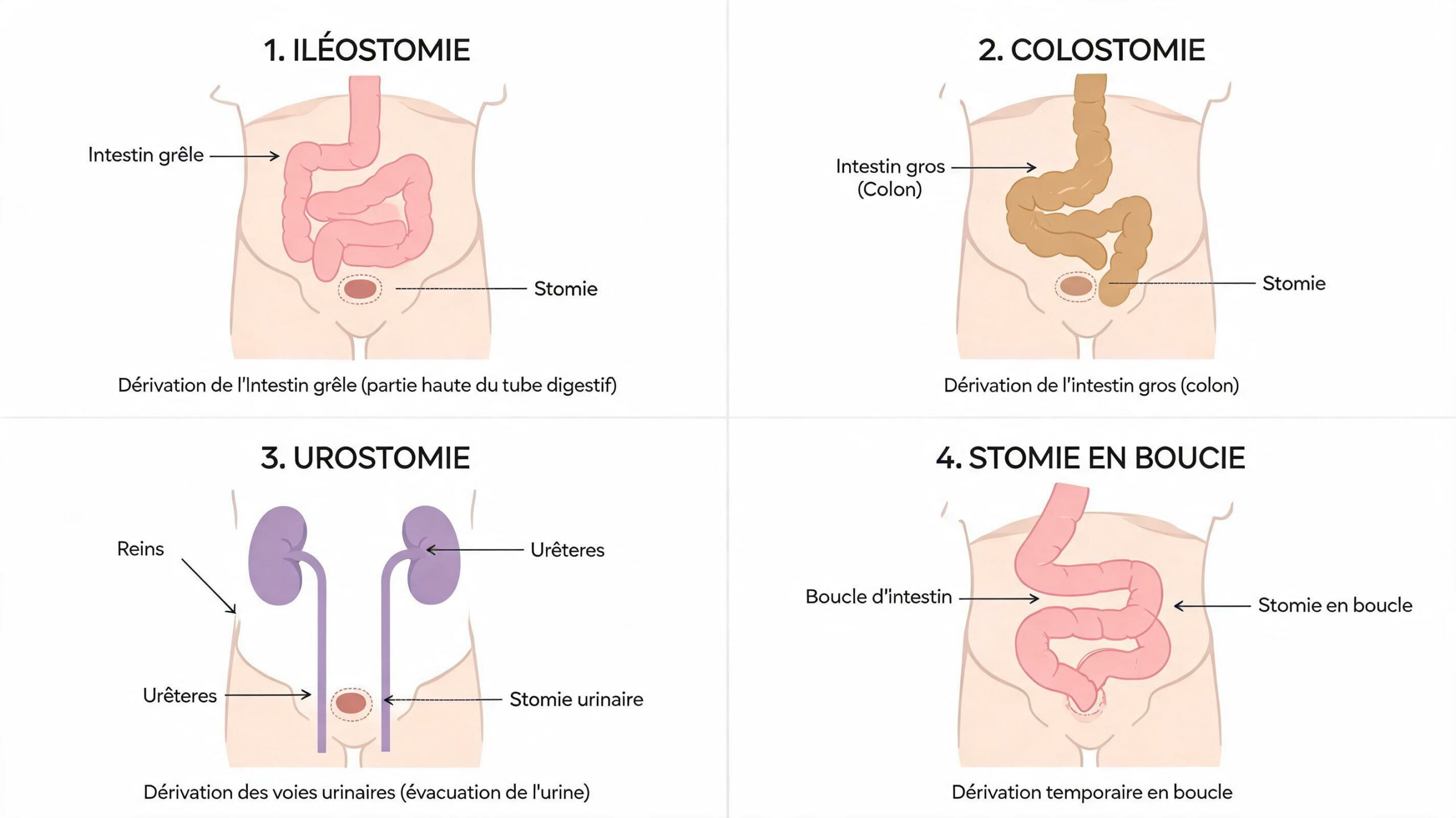 Différents types de stomies